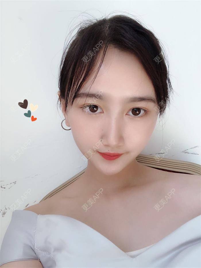 更美 - 更美用户RzgODLO8GE的私处填充经验 | 私处填充