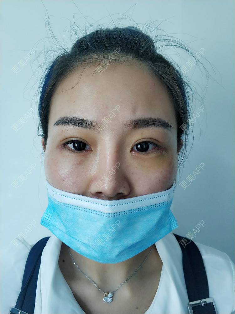 更美 - 更美用户wOARiRO1Ls的真皮丰卧蚕经验 | 北京 | 真皮丰卧蚕