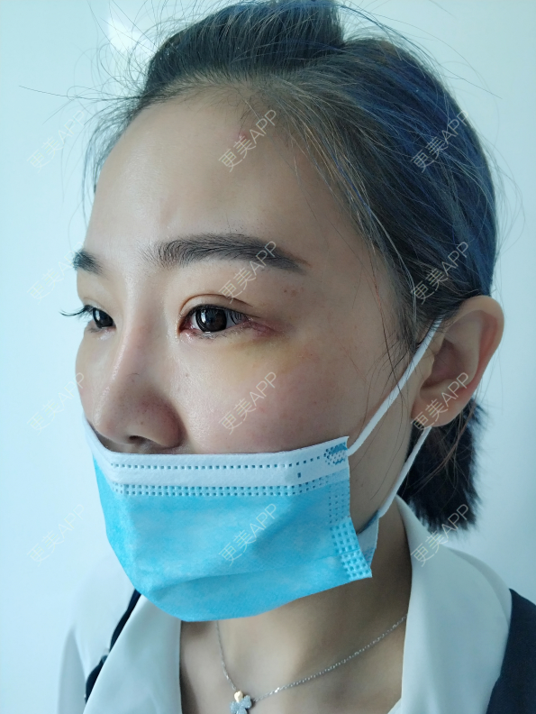 更美 - 更美用户wOARiRO1Ls的真皮丰卧蚕经验 | 北京 | 真皮丰卧蚕