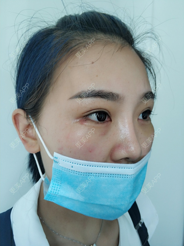 更美 - 更美用户wOARiRO1Ls的真皮丰卧蚕经验 | 北京 | 真皮丰卧蚕