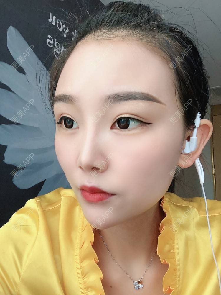 更美 - 更美用户wOARiRO1Ls的真皮丰卧蚕经验 | 北京 | 真皮丰卧蚕