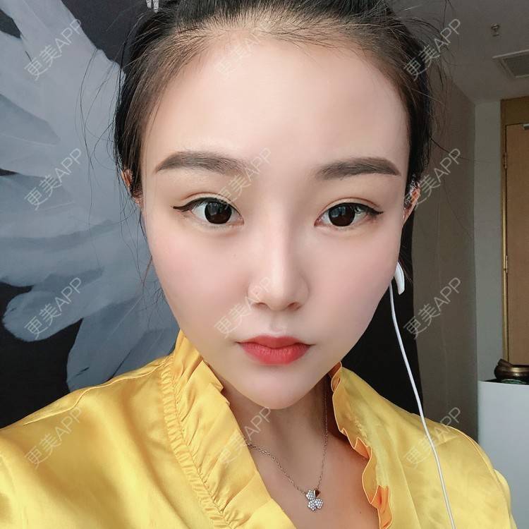 更美 - 更美用户wOARiRO1Ls的真皮丰卧蚕经验 | 北京 | 真皮丰卧蚕