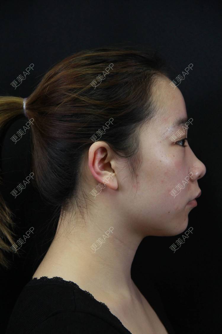 自体软骨垫鼻尖前后对比照_更美用户x3ibtjfi8x_术后462天__更美