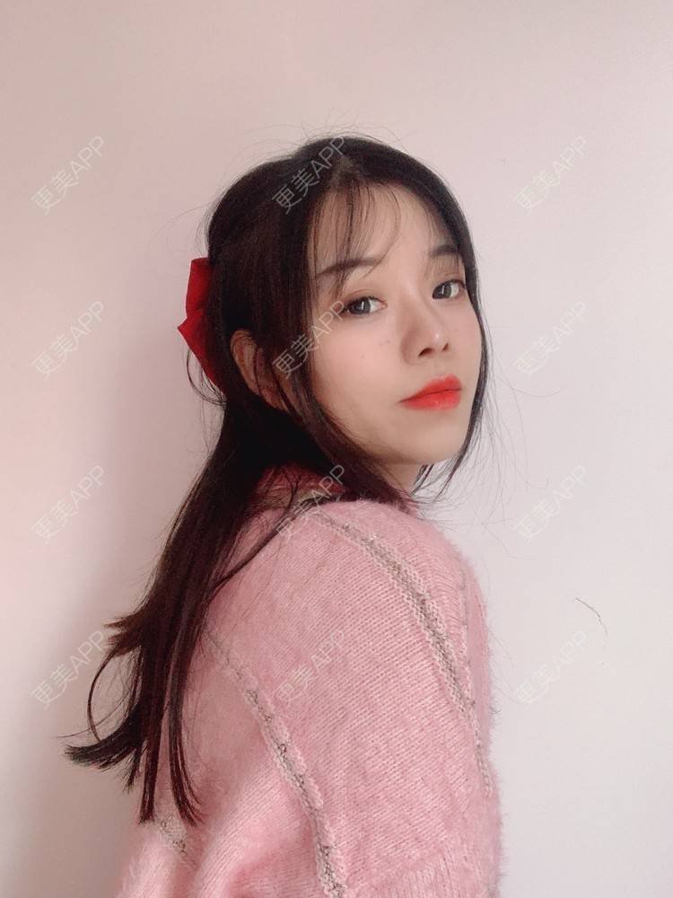 更美 - TAOYE`的颧骨内推经验 | 颧骨内推 | 下颌角 | 成都 | V脸套餐 | 下颌角切除