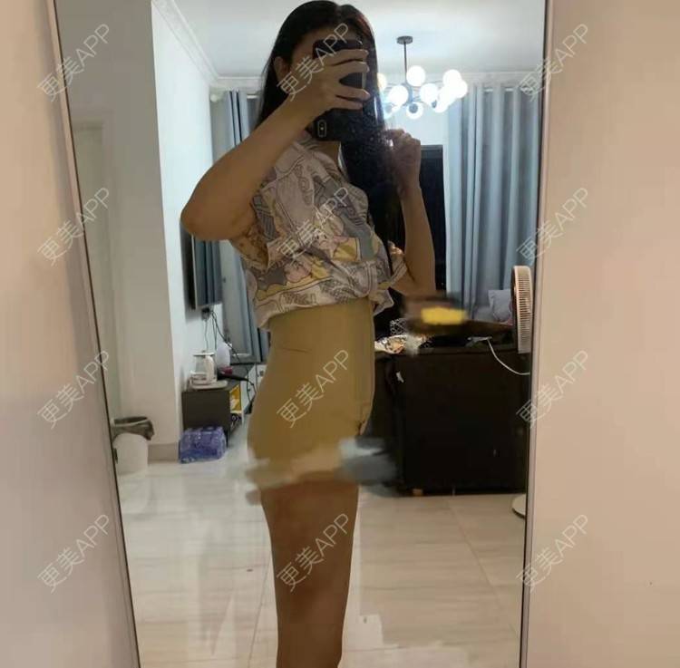 太阳花曳的腹部吸脂日记