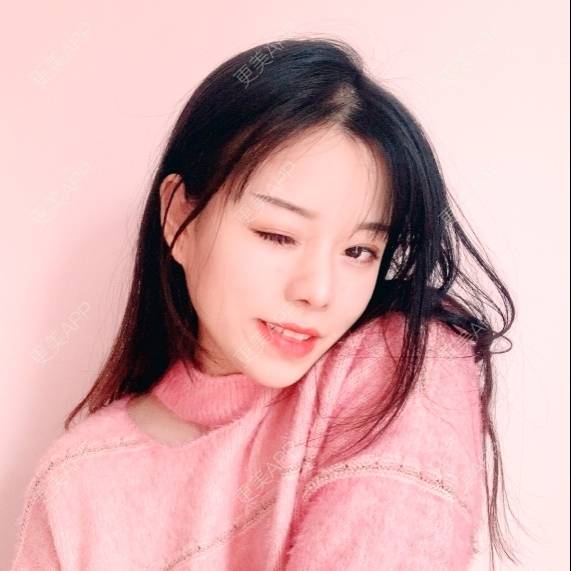 更美 - TAOYE`的颧骨内推经验 | 颧骨内推 | 下颌角 | 成都 | V脸套餐 | 下颌角切除