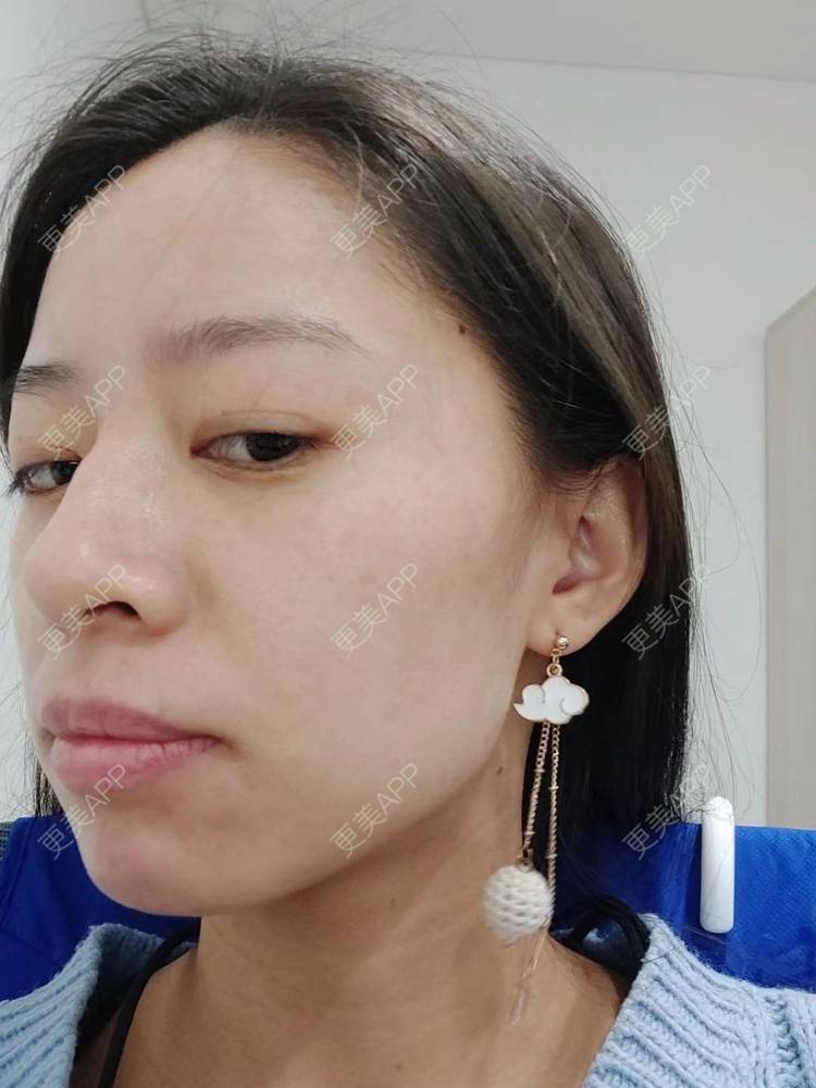 更美 - 更美用户FKgNeqD2Py的黑脸娃娃经验 | 白瓷娃娃 | 美白套餐 | 彩光嫩肤 | 光子嫩肤 | 黑脸娃娃 | 重庆 | 点阵激光 | 注射美白 | 镭射净肤 | 果酸焕肤 | 激光淡斑