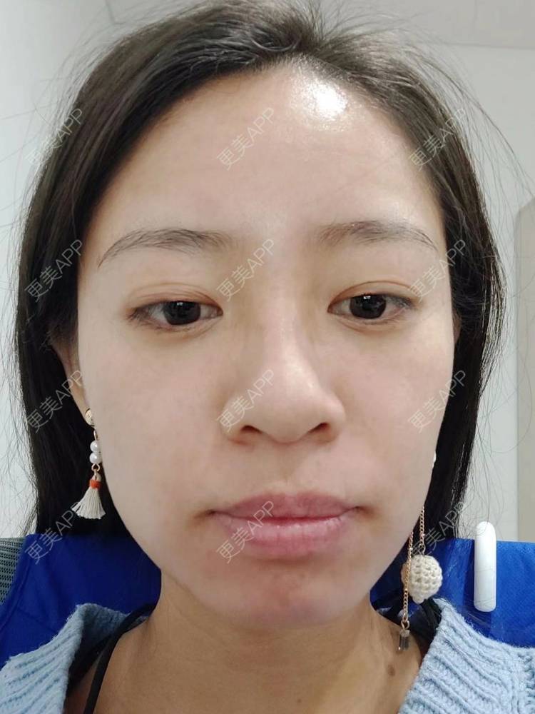 更美 - 更美用户FKgNeqD2Py的黑脸娃娃经验 | 白瓷娃娃 | 美白套餐 | 彩光嫩肤 | 光子嫩肤 | 黑脸娃娃 | 重庆 | 点阵激光 | 注射美白 | 镭射净肤 | 果酸焕肤 | 激光淡斑