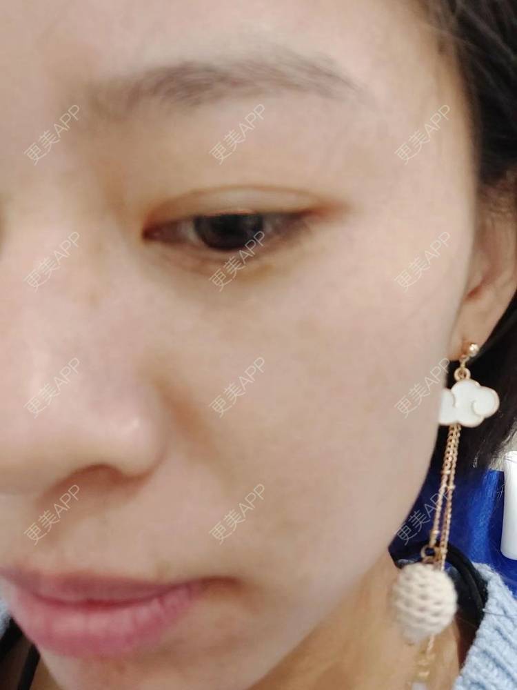 更美 - 更美用户FKgNeqD2Py的黑脸娃娃经验 | 白瓷娃娃 | 美白套餐 | 彩光嫩肤 | 光子嫩肤 | 黑脸娃娃 | 重庆 | 点阵激光 | 注射美白 | 镭射净肤 | 果酸焕肤 | 激光淡斑