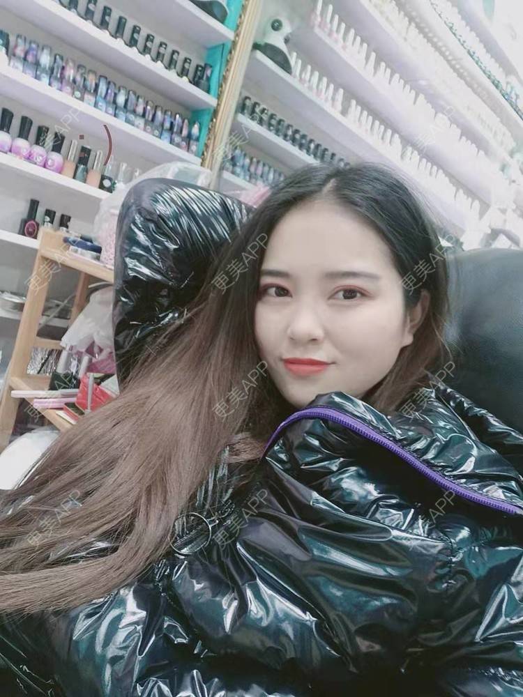 更美 - 更美用户uK1ce6rfue的全切双眼皮经验 | 广州 | 全切双眼皮