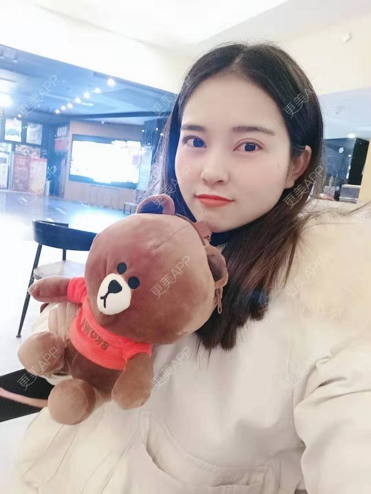 更美 - 更美用户uK1ce6rfue的全切双眼皮经验 | 广州 | 全切双眼皮