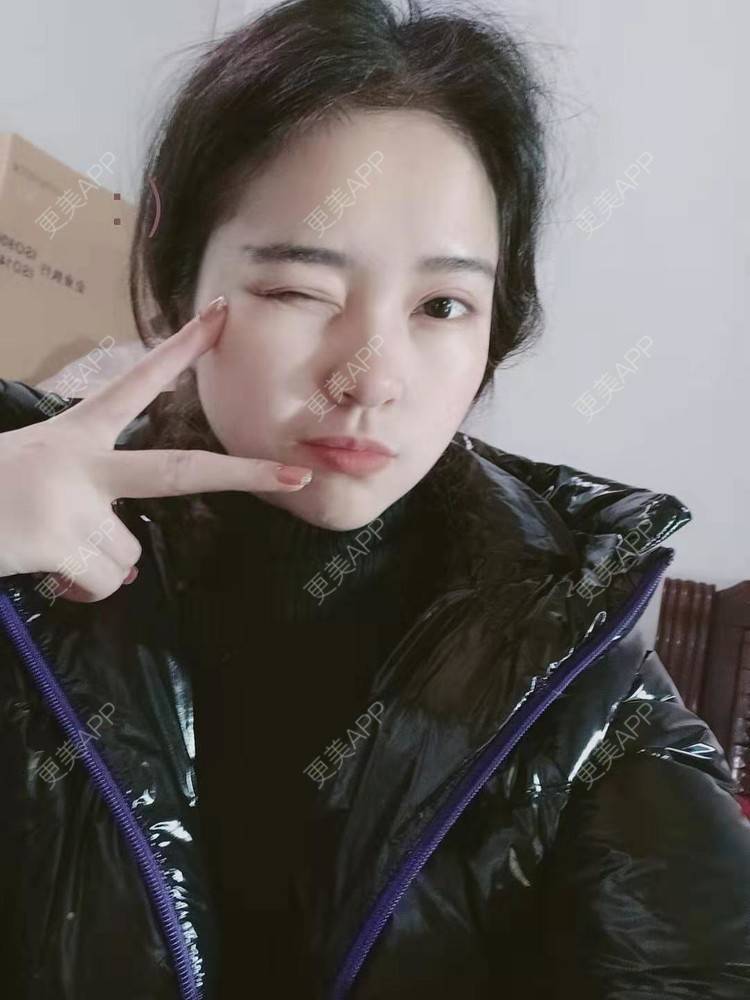 更美 - 更美用户uK1ce6rfue的全切双眼皮经验 | 广州 | 全切双眼皮