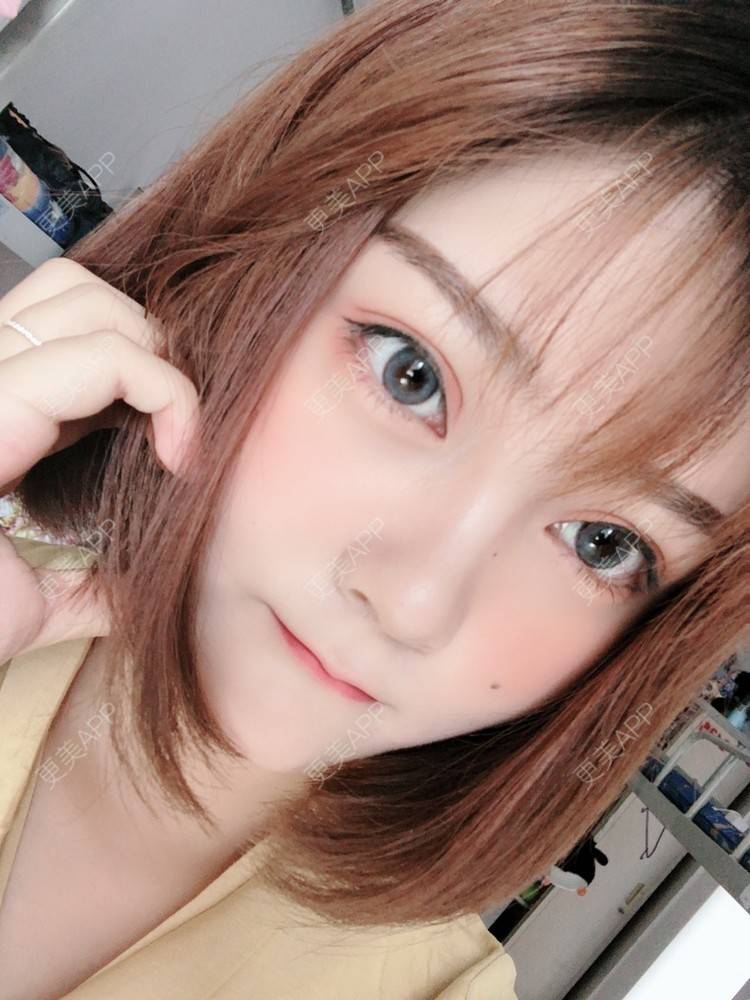 更美 - 你这只丑陋的土拨鼠的自体脂肪丰卧蚕经验 | 自体脂肪丰卧蚕