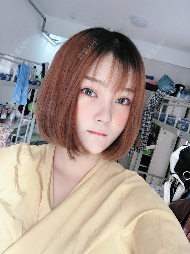 更美 - 你这只丑陋的土拨鼠的自体脂肪丰卧蚕经验 | 自体脂肪丰卧蚕