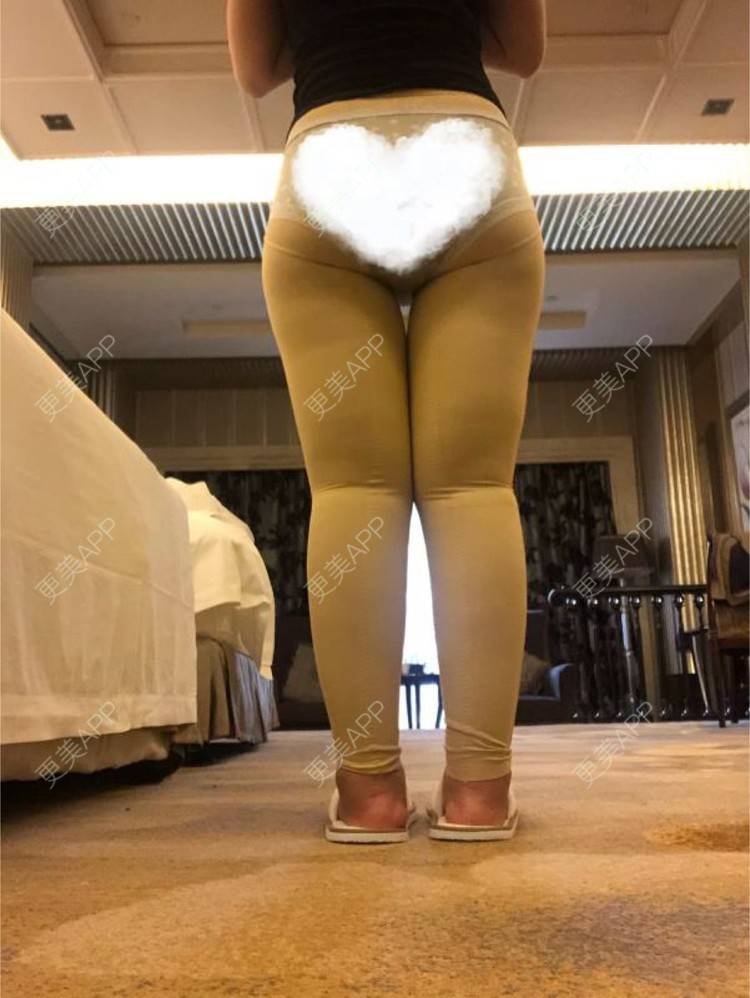 更美 - 更美用户0KW89OwG5c的吸脂去副乳经验 | 吸脂去副乳 | 北京