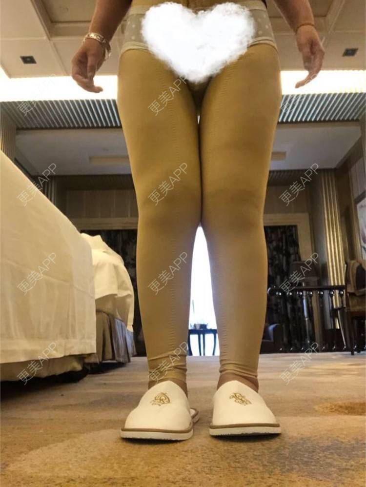 更美 - 更美用户0KW89OwG5c的吸脂去副乳经验 | 吸脂去副乳 | 北京