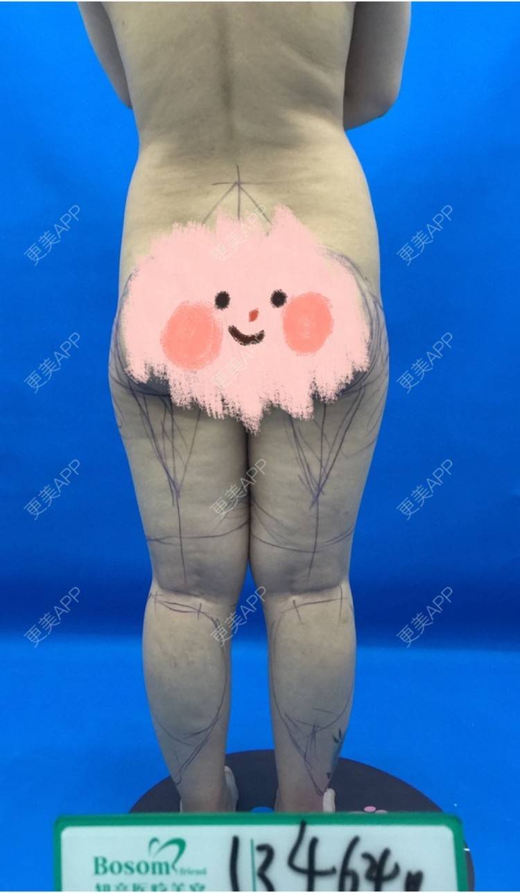 更美 - 更美用户0KW89OwG5c的吸脂去副乳经验 | 吸脂去副乳 | 北京