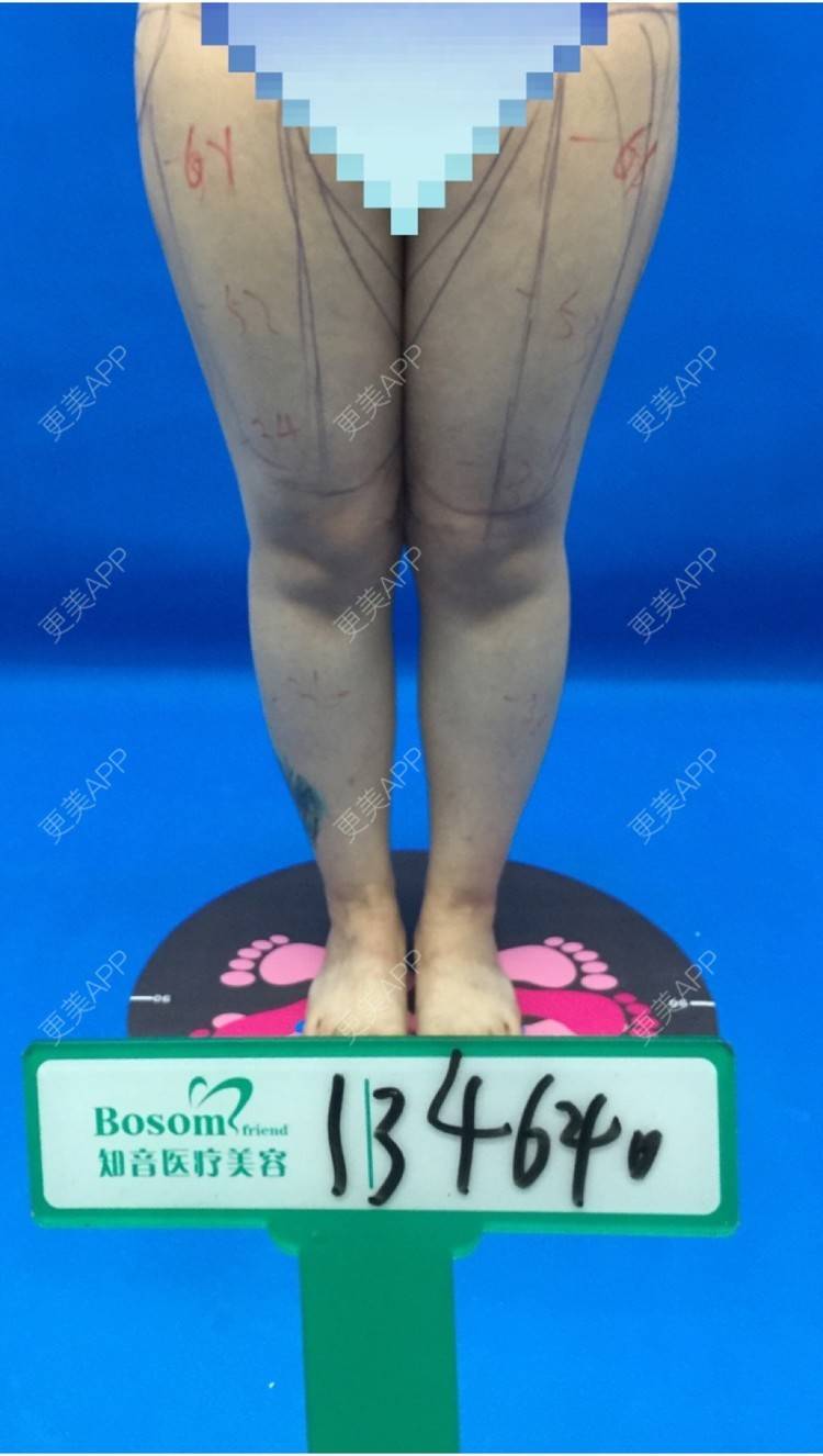 更美 - 更美用户0KW89OwG5c的吸脂去副乳经验 | 吸脂去副乳 | 北京