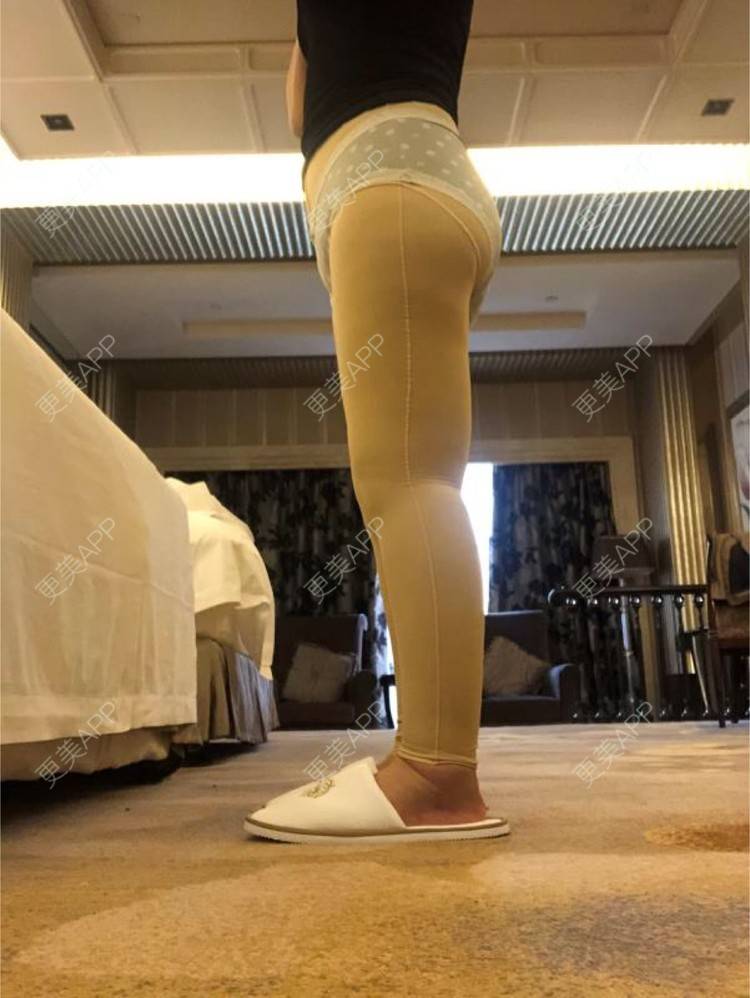 更美 - 更美用户0KW89OwG5c的吸脂去副乳经验 | 吸脂去副乳 | 北京