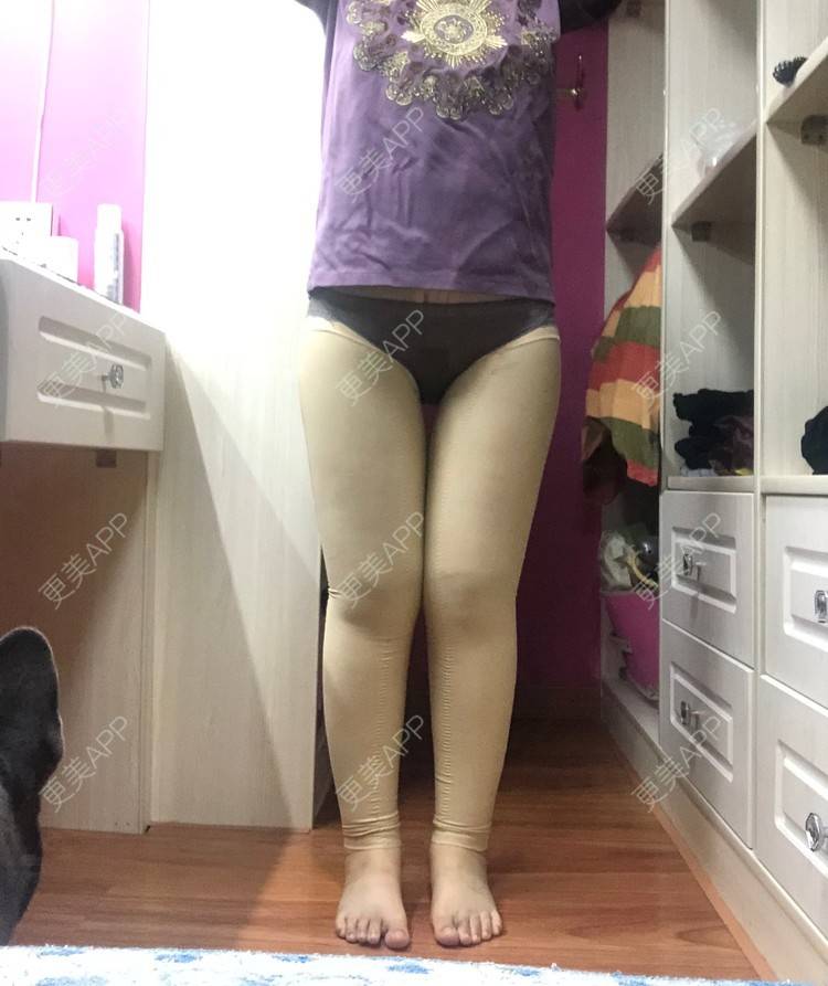 更美 - 更美用户0KW89OwG5c的吸脂去副乳经验 | 北京 | 吸脂去副乳