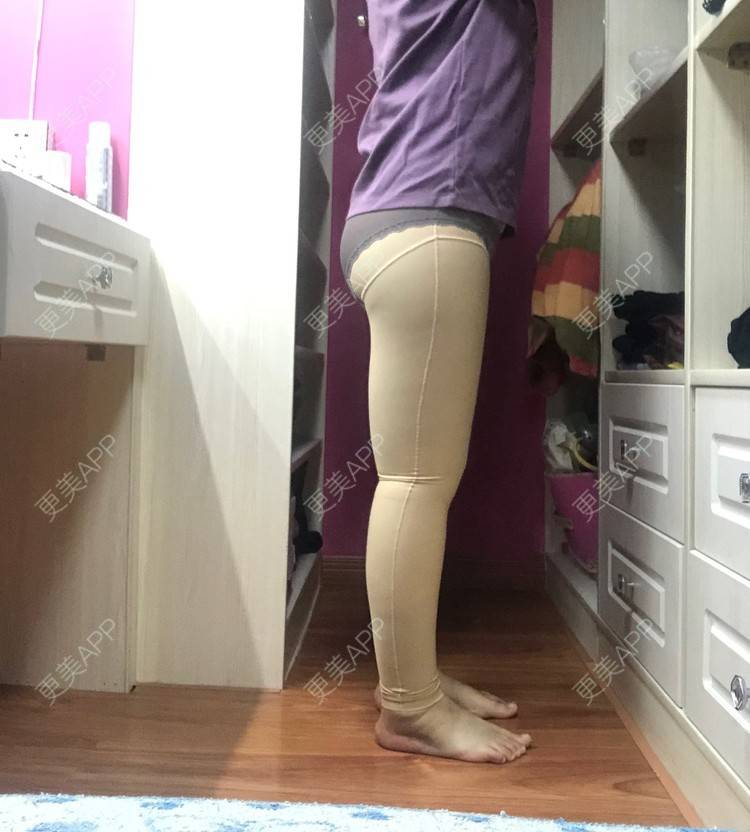 更美 - 更美用户0KW89OwG5c的吸脂去副乳经验 | 北京 | 吸脂去副乳