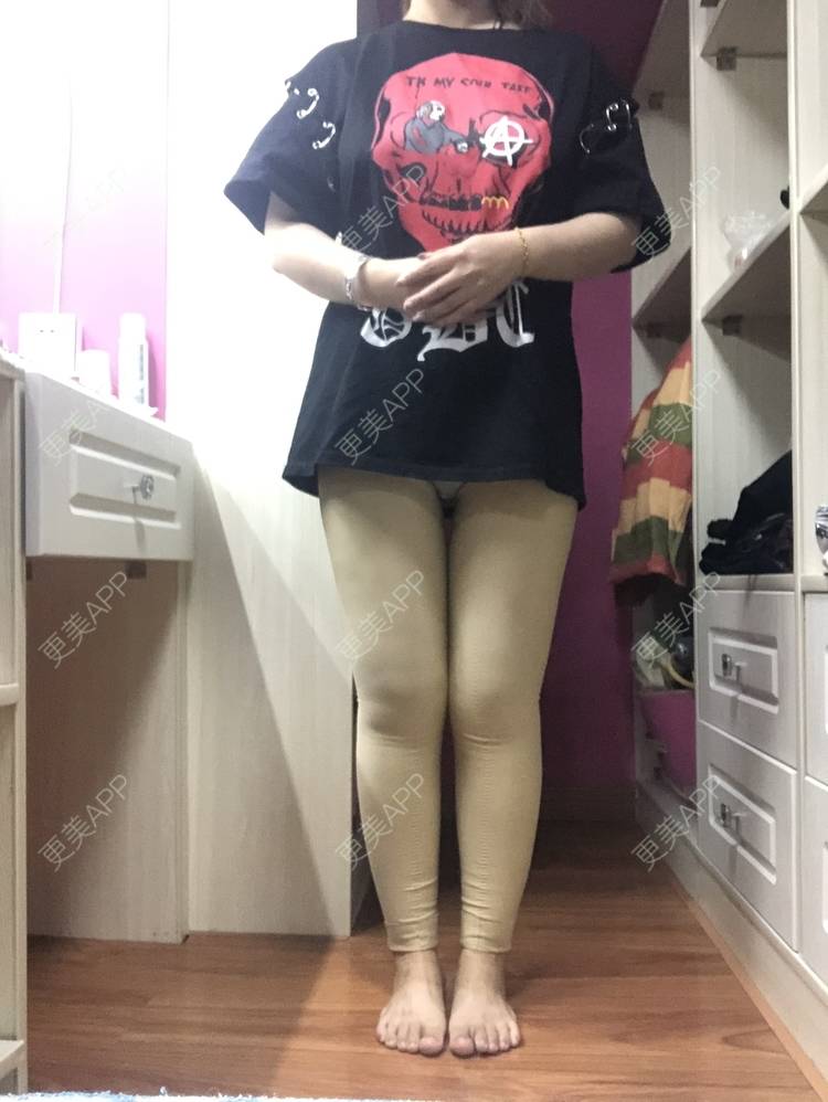更美 - 更美用户0KW89OwG5c的吸脂去副乳经验 | 北京 | 吸脂去副乳