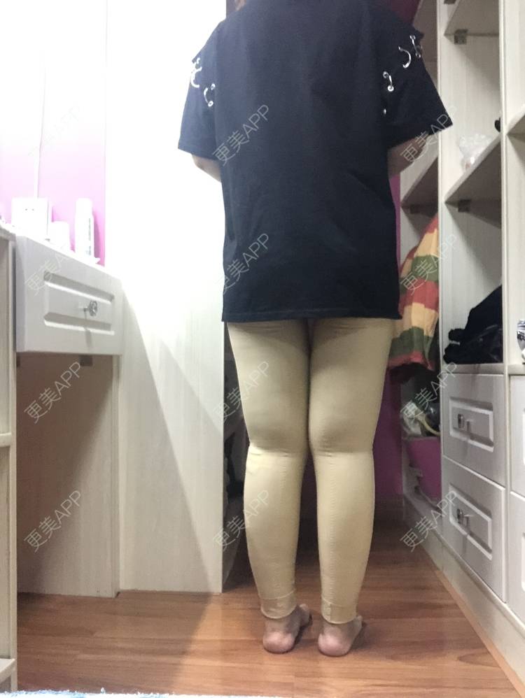 更美 - 更美用户0KW89OwG5c的吸脂去副乳经验 | 北京 | 吸脂去副乳
