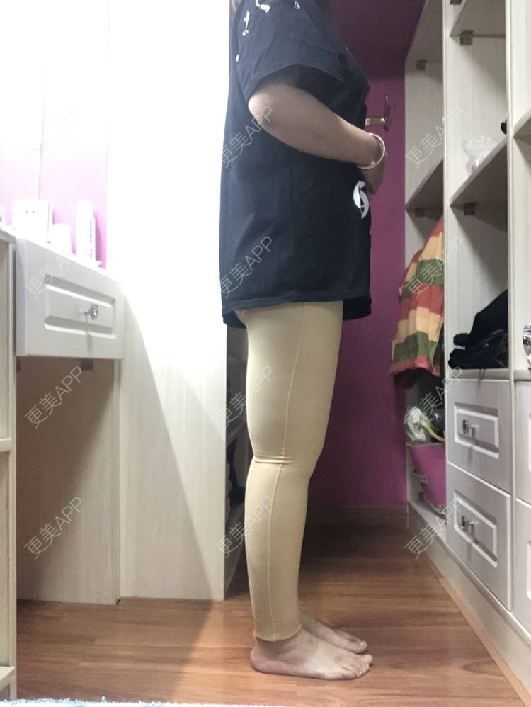 更美 - 更美用户0KW89OwG5c的吸脂去副乳经验 | 北京 | 吸脂去副乳