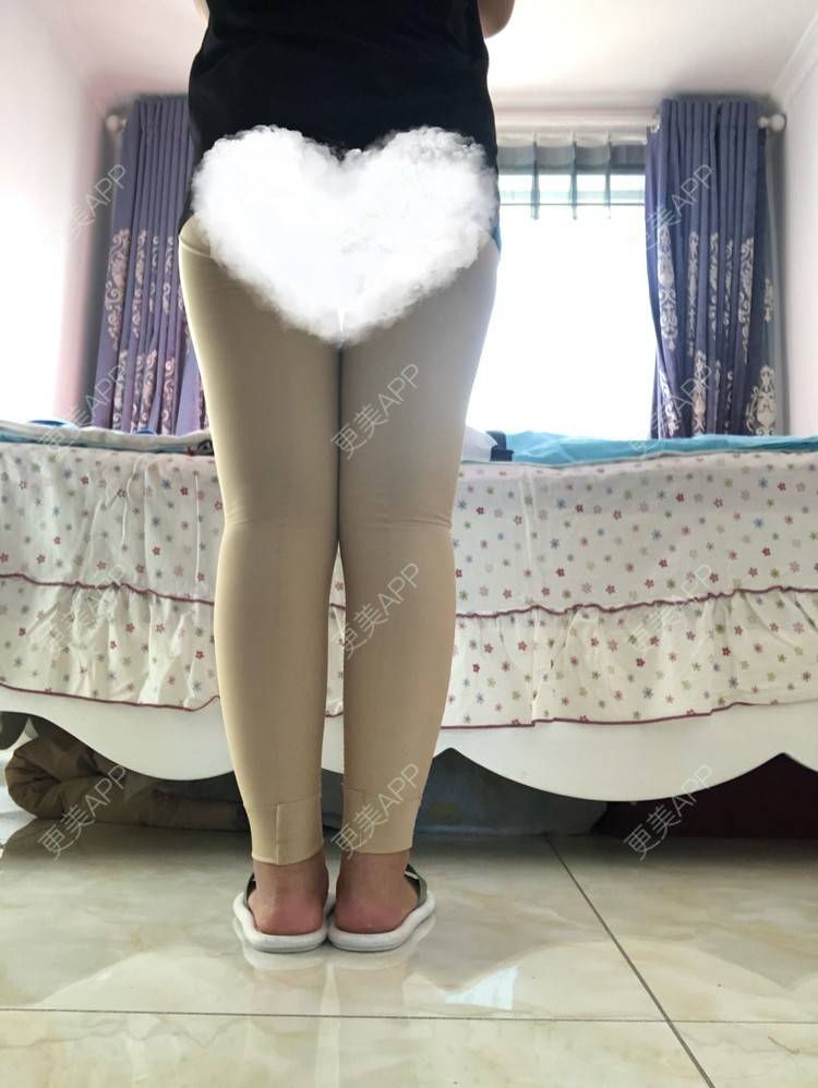更美 - 更美用户0KW89OwG5c的吸脂去副乳经验 | 北京 | 吸脂去副乳