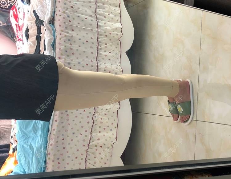 更美 - 更美用户0KW89OwG5c的吸脂去副乳经验 | 北京 | 吸脂去副乳