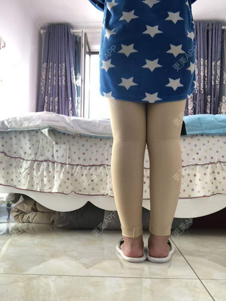 更美 - 更美用户0KW89OwG5c的吸脂去副乳经验 | 北京 | 吸脂去副乳