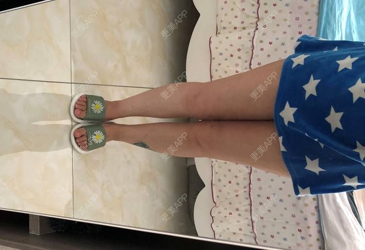 更美 - 更美用户0KW89OwG5c的吸脂去副乳经验 | 北京 | 吸脂去副乳