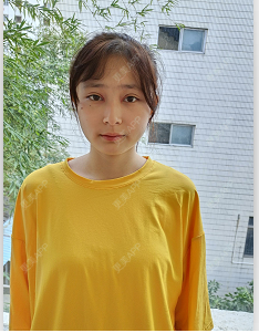 更美 - 小野素曦杨的全切双眼皮经验 | 全切双眼皮 | 深圳