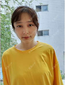 更美 - 小野素曦杨的全切双眼皮经验 | 全切双眼皮 | 深圳