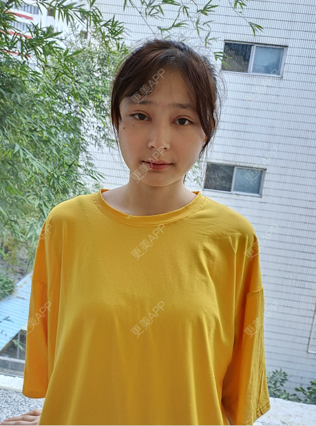 更美 - 小野素曦杨的全切双眼皮经验 | 全切双眼皮 | 深圳