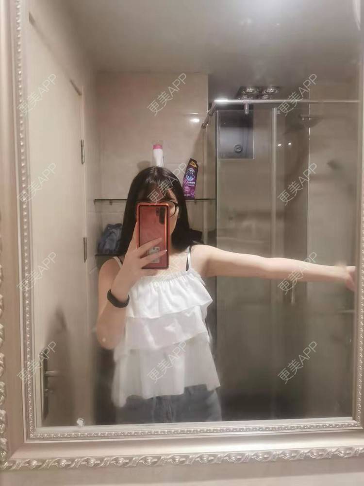 更美 - 更美用户jHjijlJNxV的手臂吸脂经验 | 手臂吸脂 | 广州