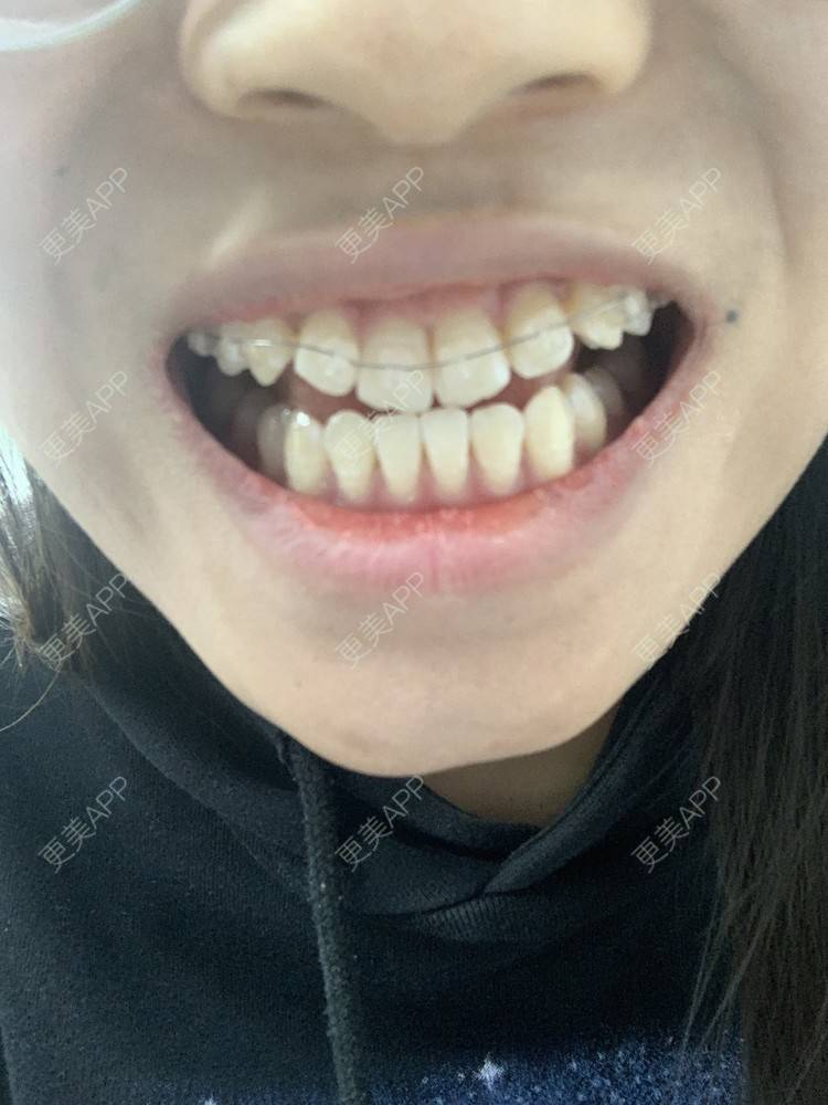 更美 - 听说°&的牙齿矫正经验 | 牙齿矫正 | 北京 | 金属托槽矫正
