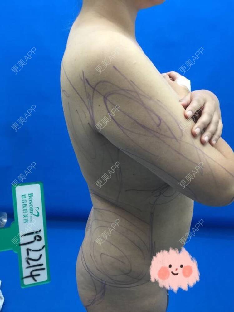 更美 - 更美用户EYmYfiEnDU的吸脂去副乳经验 | 吸脂去副乳 | 北京
