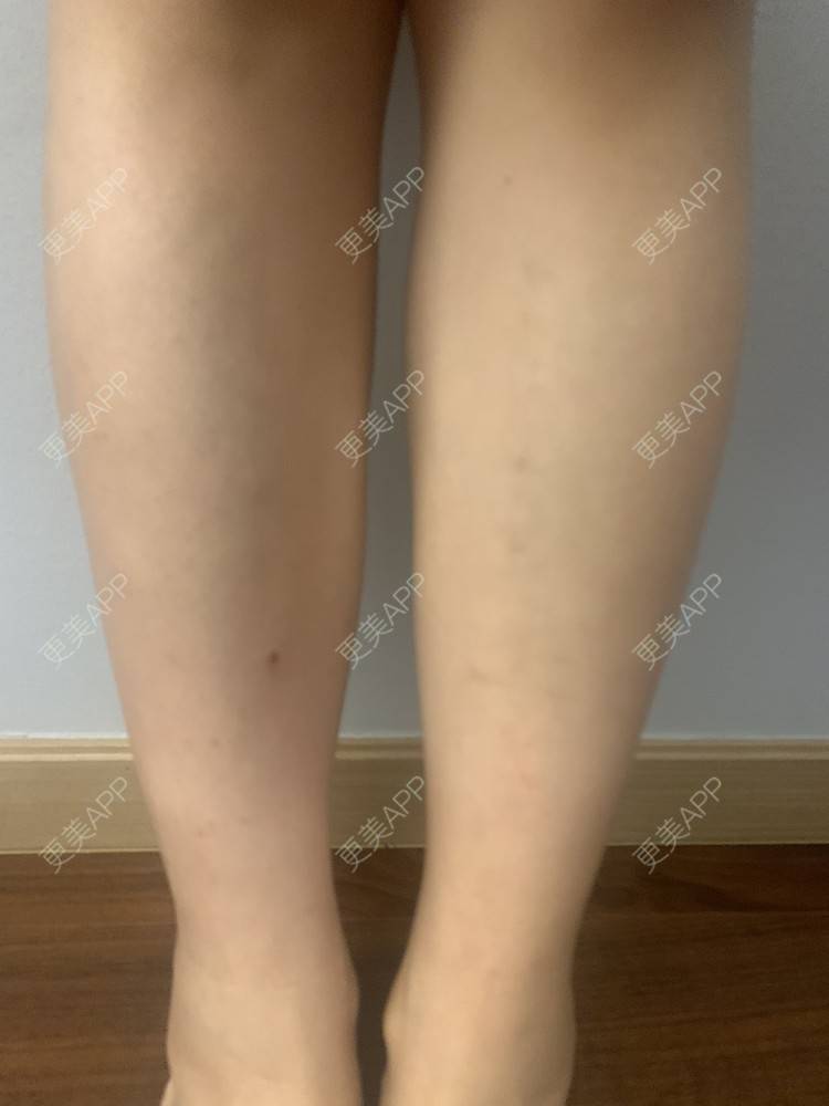 更美 - 更美用户RnKofjnKwg的除皱瘦脸经验 | 注射塑形腿部 | 除皱瘦脸 | 南京