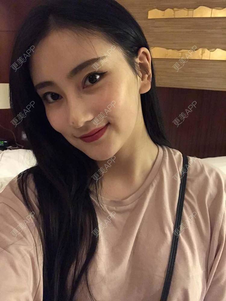 更美 - 你的奶酪掉了的埋线提升经验 | 埋线提升 | 视频日记 | 重庆