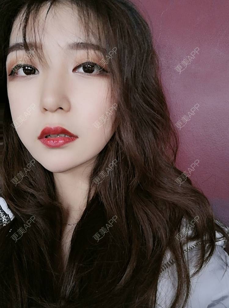 更美 - 柠汽水的埋线提升经验 | 埋线提升 | 南昌