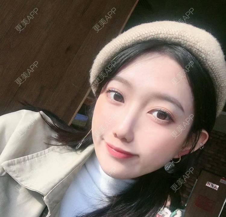 更美 - 不远行的埋线提升经验 | 埋线提升 | 南昌