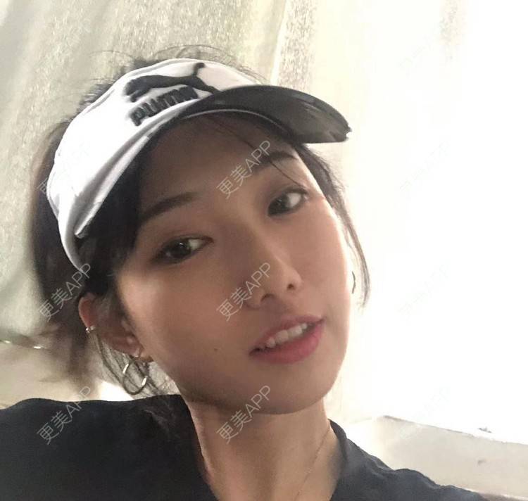 更美 - 不远行的埋线提升经验 | 埋线提升 | 南昌