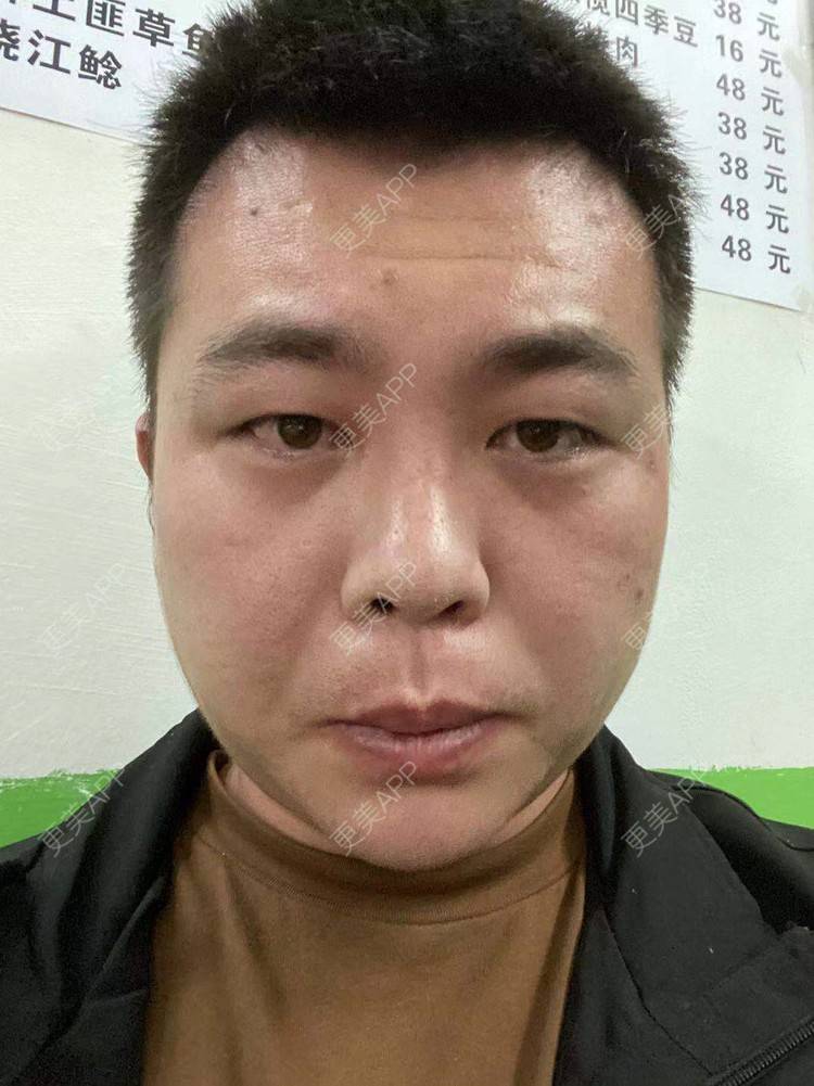更美 - 更美用户CpEUucbuzR的鬓角植发经验 | 植发际线 | 毛发移植 | 头顶加密种植 | 鬓角植发 | 美人尖植发