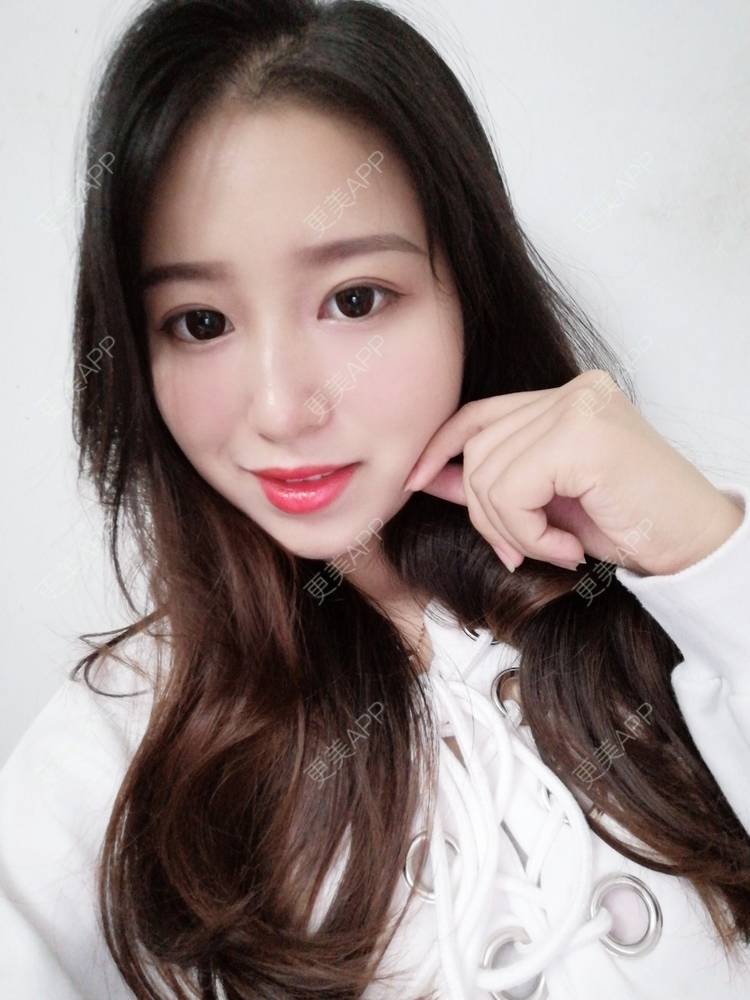 更美 - 做你心里的鬼的自体脂肪丰卧蚕经验 | 自体脂肪丰卧蚕