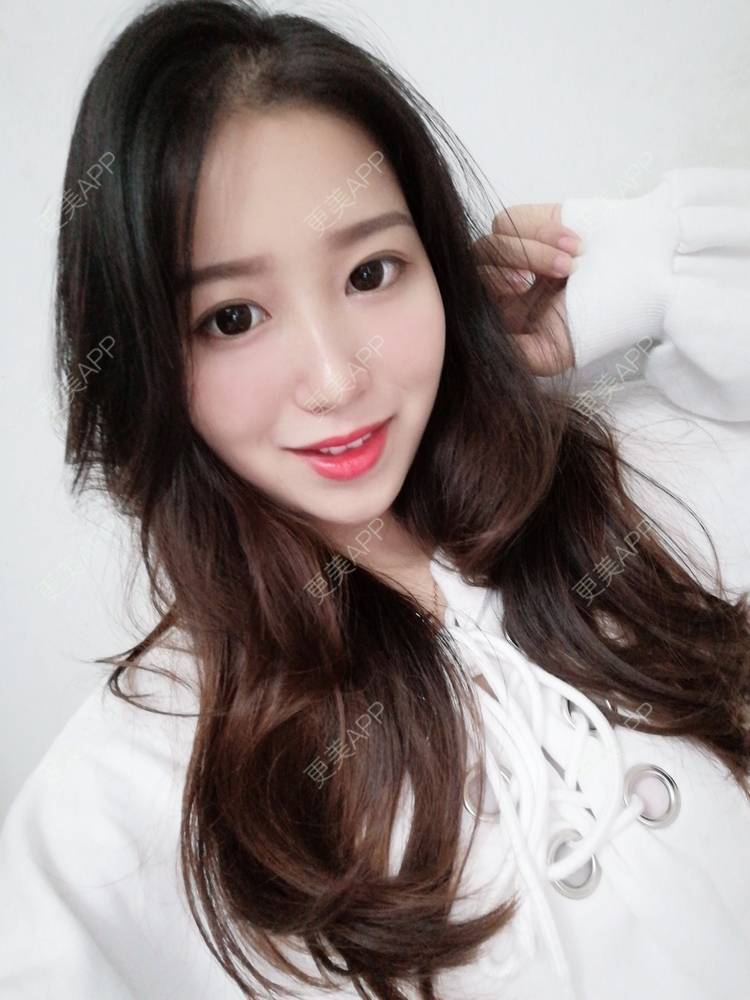 更美 - 做你心里的鬼的自体脂肪丰卧蚕经验 | 自体脂肪丰卧蚕