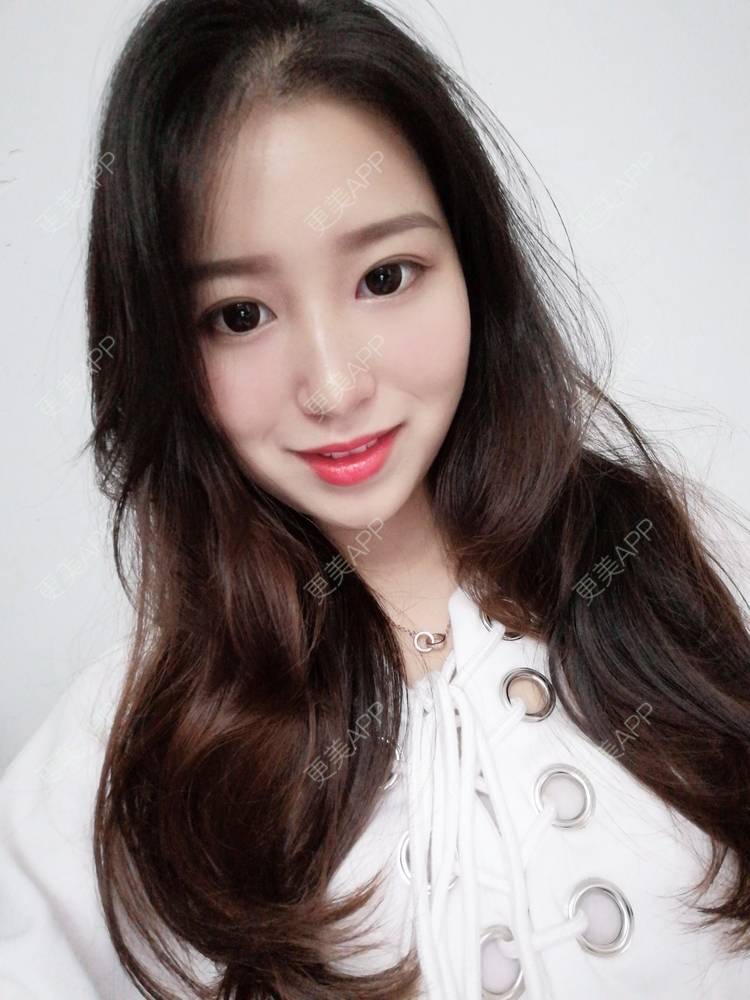 更美 - 做你心里的鬼的自体脂肪丰卧蚕经验 | 自体脂肪丰卧蚕