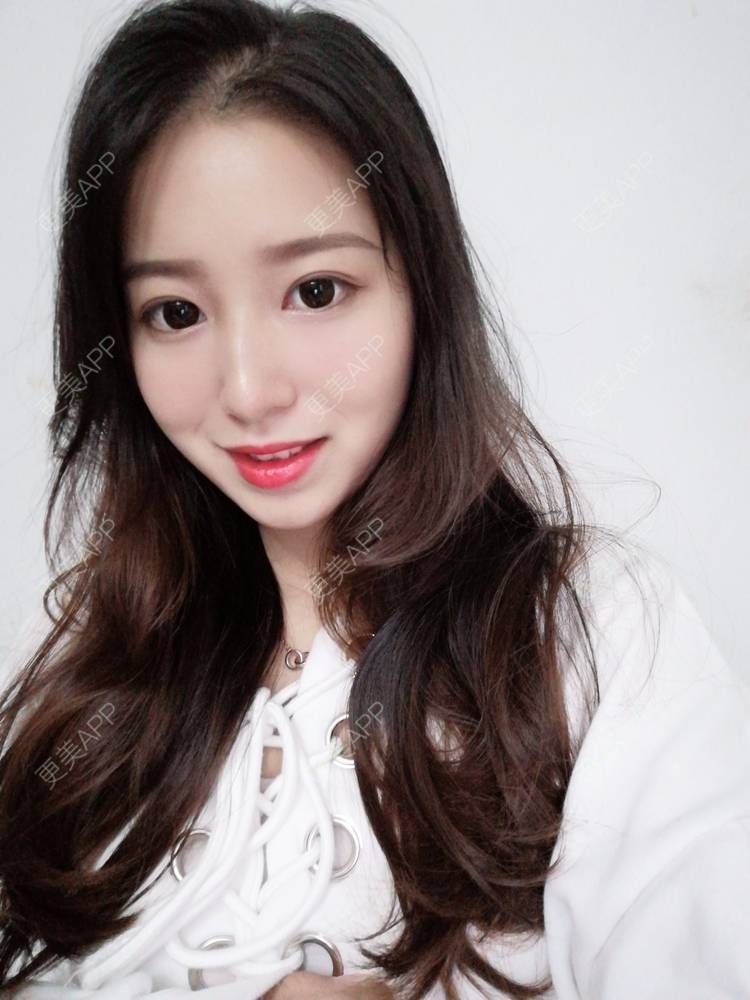 更美 - 做你心里的鬼的自体脂肪丰卧蚕经验 | 自体脂肪丰卧蚕