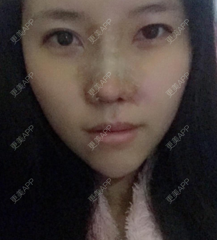 更美 - 更美用户DNEBeajwSz的埋线隆鼻经验 | 埋线隆鼻