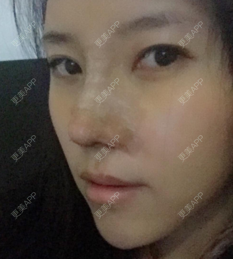 更美 - 更美用户DNEBeajwSz的埋线隆鼻经验 | 埋线隆鼻